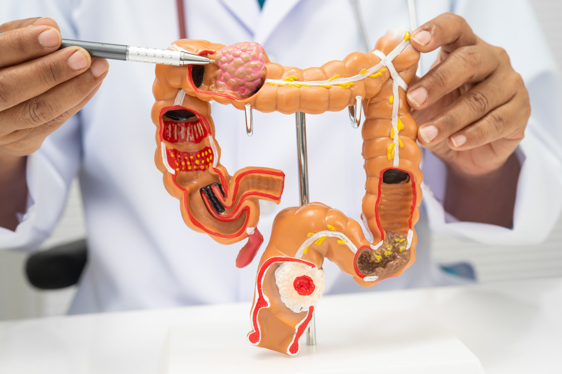 New Colon Cancer Blood Test Explained