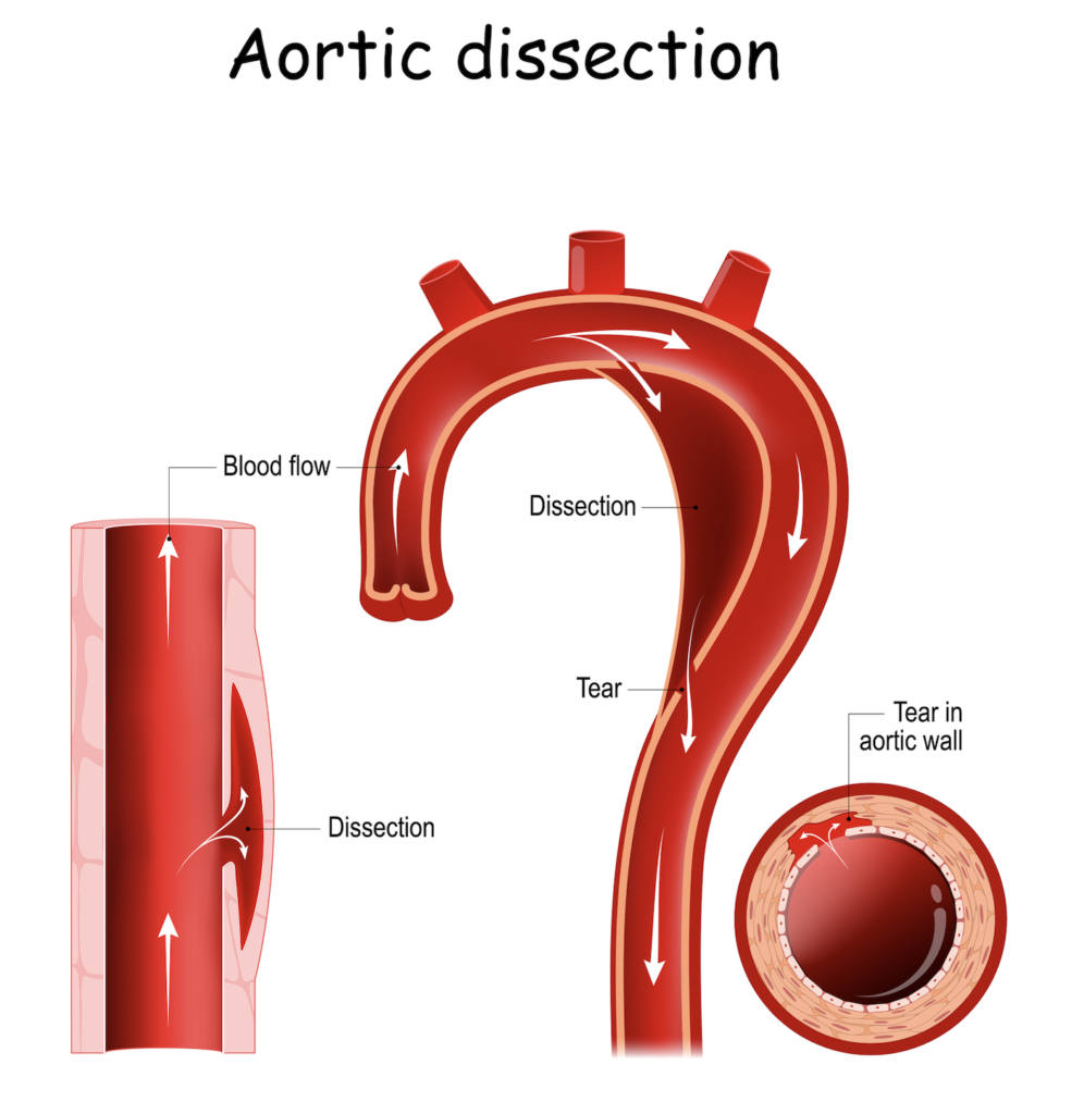 Aortic dissection. injury to the innermost layer of the aorta. blood to flow between the layers of the aortic wall. aortic arch. longitudinal and cross-section of blood vessel.